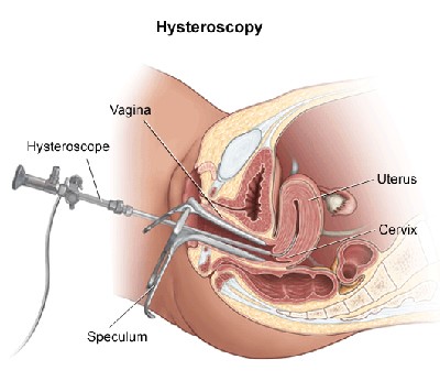 Hysteroscopy In Marathahalli, Bangalore