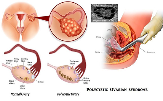 Polycystic Ovary Syndrome (PCOS) In Marathahalli