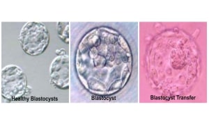 Blastocyst Transfer in Kundalahalli