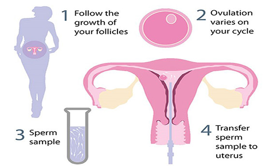 IUI Treatment In Marathahalli