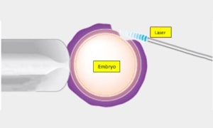 Laser Assisted Hatching in Bangalore