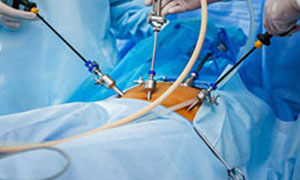 Laparoscopic Surgery In Marathahalli, Bangalore